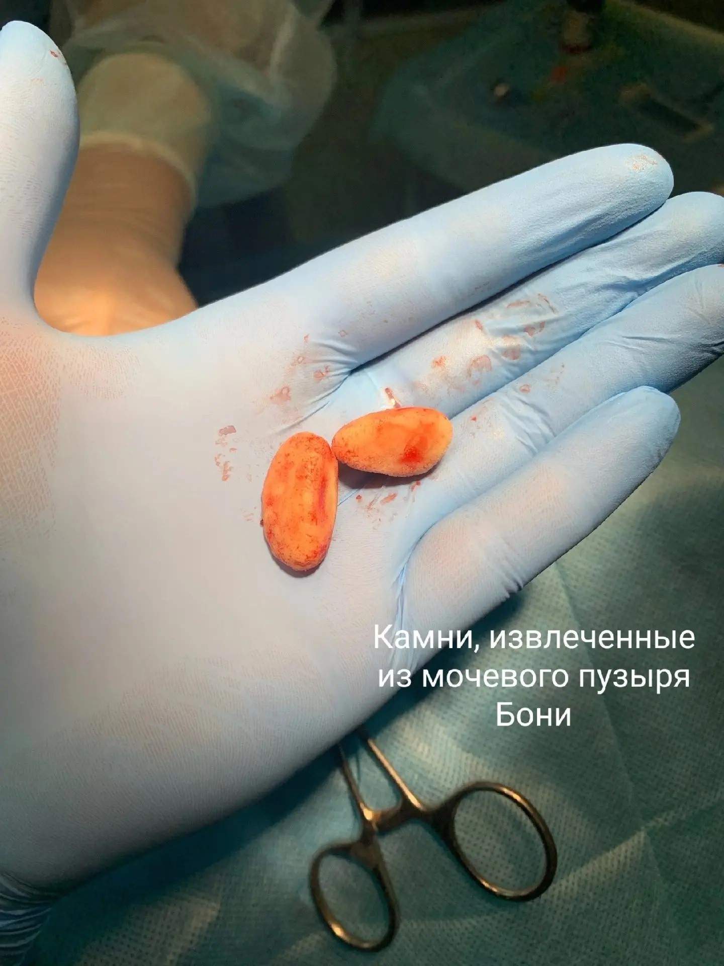 Камни, извлечённые из мочевого пузыря Бони